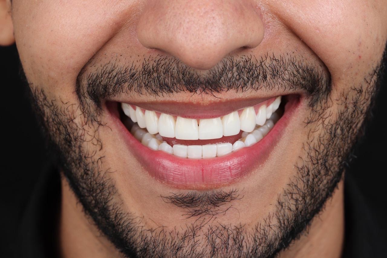 Sonrisa y resultado de tratamiento odontológico de la Dra. Daniela Pérez