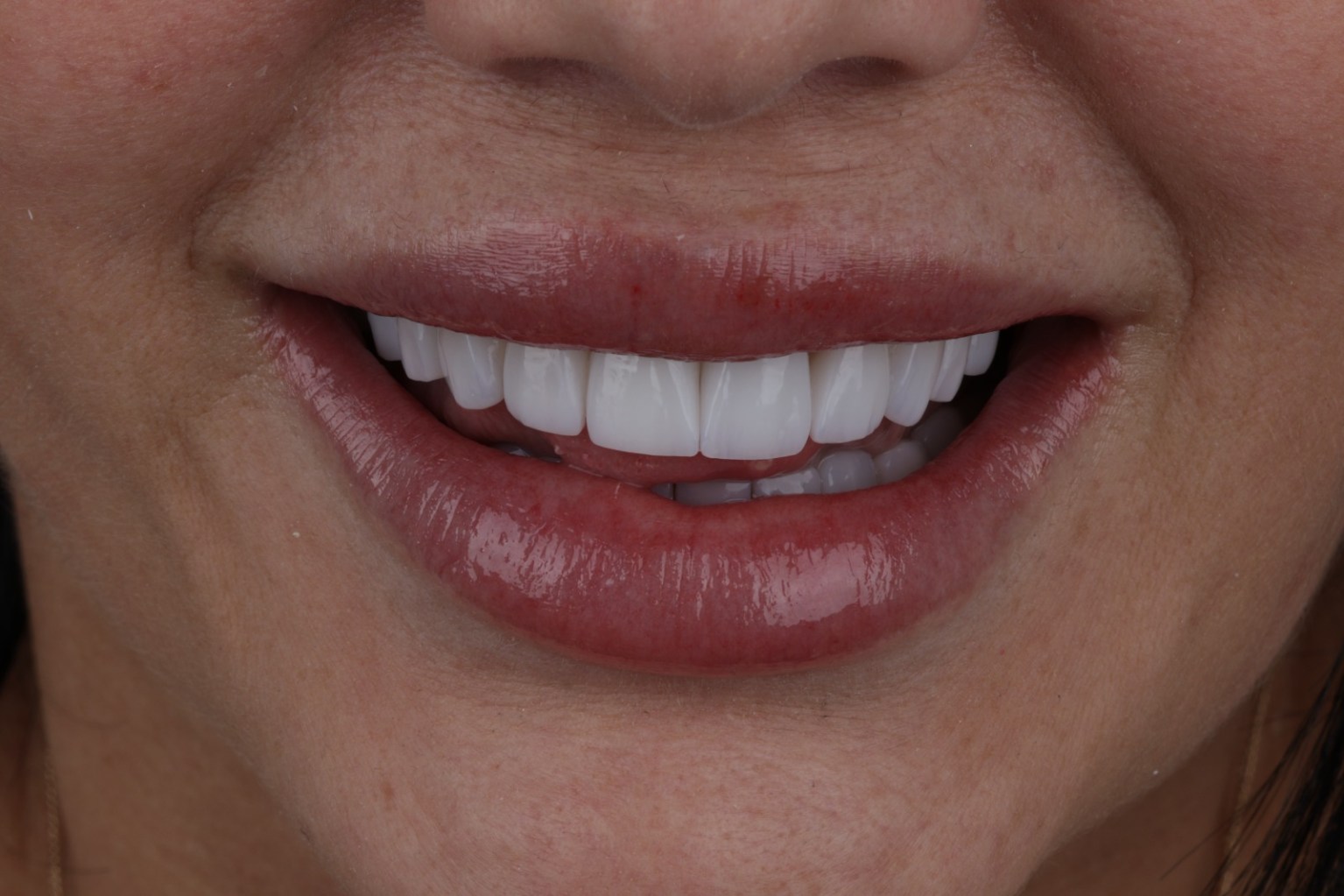 Después del diseño de sonrisa - Dra. Daniela Pérez