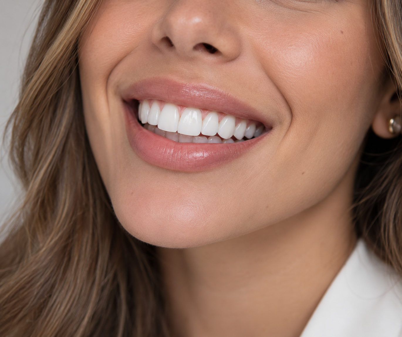 Sonrisa diseñada con resina